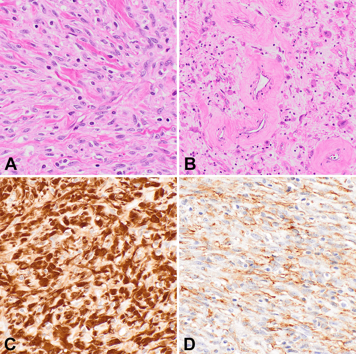 Frontiers  Nodular and diffuse spindle cell infiltration in