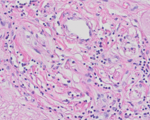 Adrenal Gland | College of American Pathologists