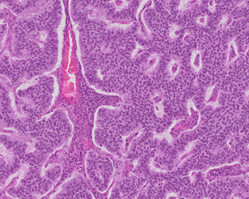 Peripancreatic Lymph Node | College of American Pathologists