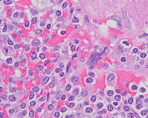 Spleen | College of American Pathologists