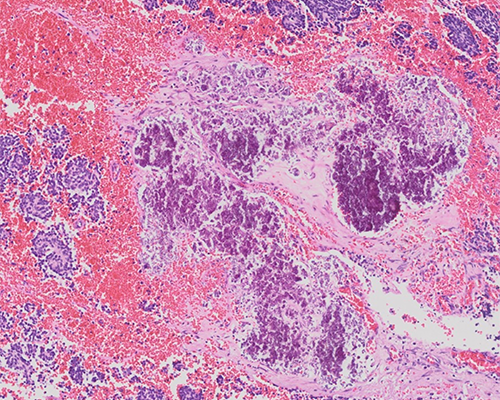 Posterior Mediastinal Mass | College of American Pathologists