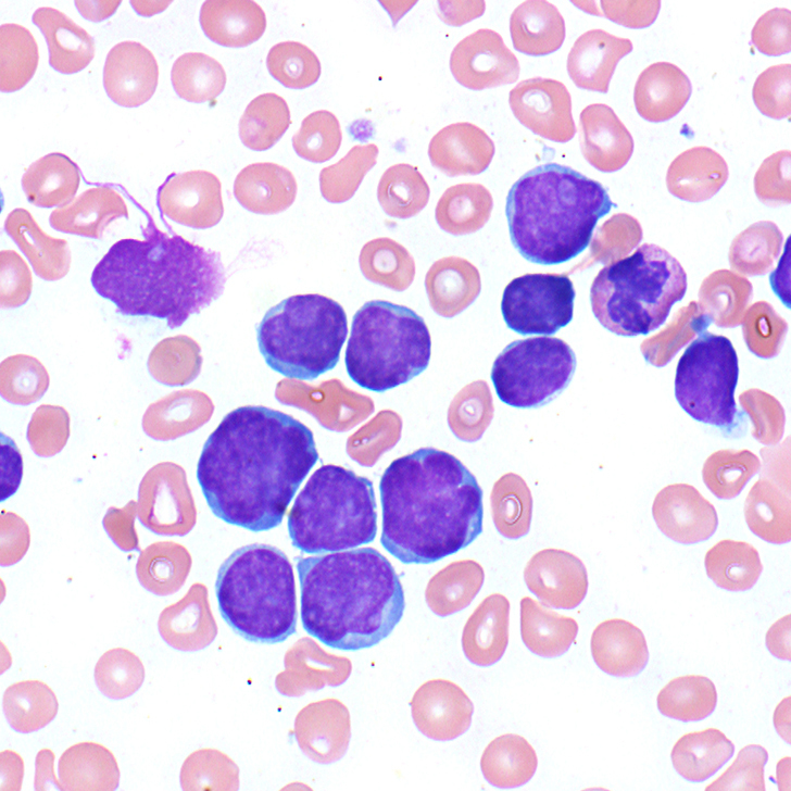 T Lymphoblastic Leukemialymphoma College Of American Pathologists 